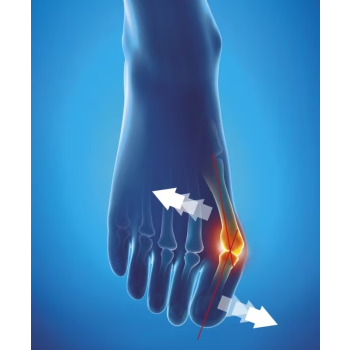 Orthèse corrective Hallux Valgus de jour Epitact