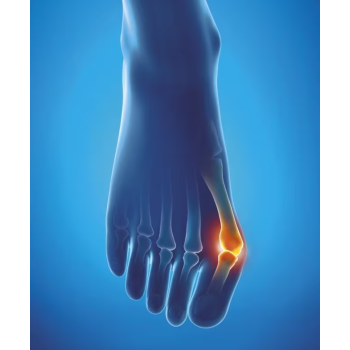 Protection Hallux Valgus Epitact