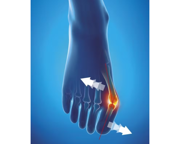 Orthèse corrective Hallux Valgus de jour Epitact