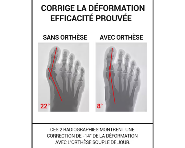 Orthèse corrective Hallux Valgus de jour Epitact
