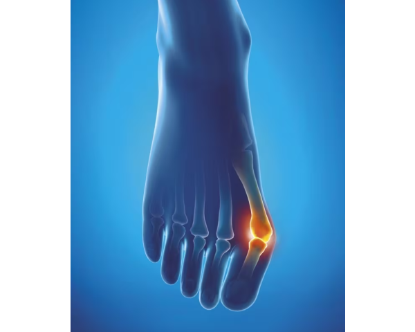 Protection Hallux Valgus Epitact