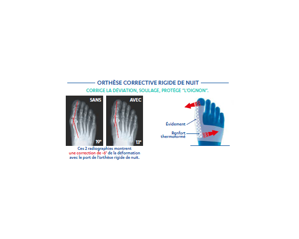 Orthèse corrective rigide de Nuit Hallux Valgus