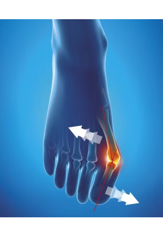 Orthèse corrective Hallux Valgus de jour Epitact