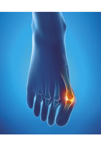 Protection Hallux Valgus Epitact